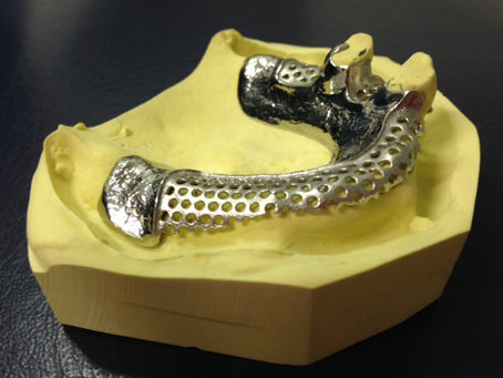 Partial Dentures