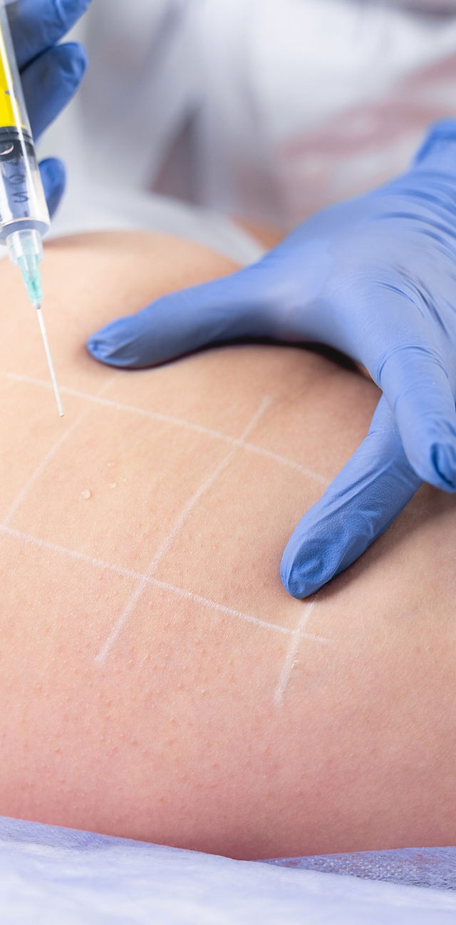 lemon bottle fat dissolving needles Lemonbottle fat dissolving