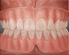 Dentures placed over implants to replace all a patient's missing teeth.