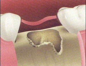 Defects following tooth extraction