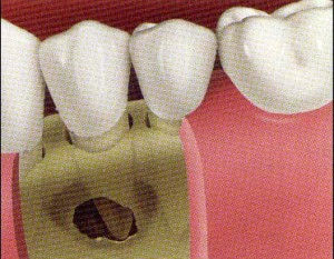Defects following cyst or tumor surgery