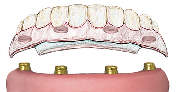 Dental implants can support a full denture - making it feel safe and secure. This allows a person to smile and chew with confidence.