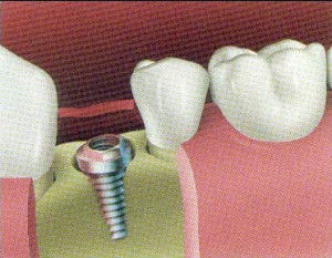 Defects around dental implants