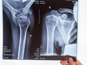 Rotator Cuff Pain — Do You Need Surgery?
