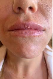 Lips and nasel labial folds
