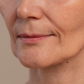 nasolabial folds wrinkle reduction