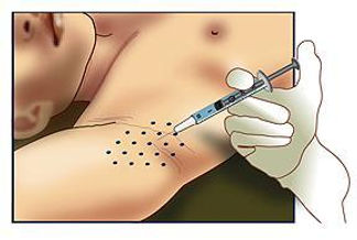 1301532682_96272557_1-Fotos-de--TRATAMIENTO-DE-SUDORACIoN-EXCESIVA-EN-AXILAS-HIPERHIDROSIS