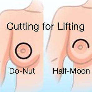 Breast reduction 26.jpg
