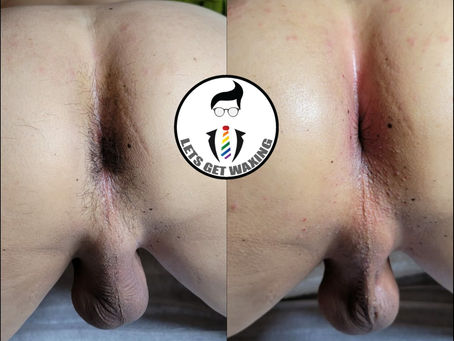 B9 肛門,股溝 $300