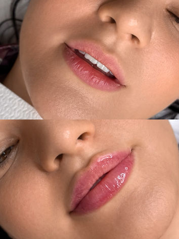 alennukset täyteainehoidoista