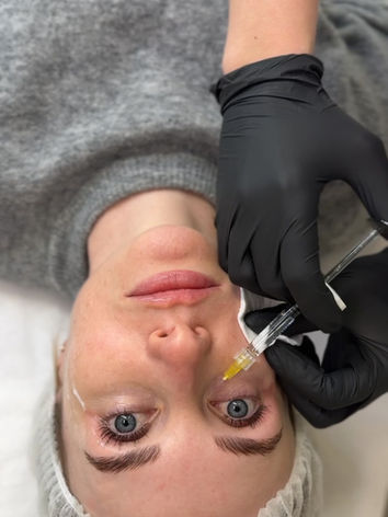 mesoterapia tulokset