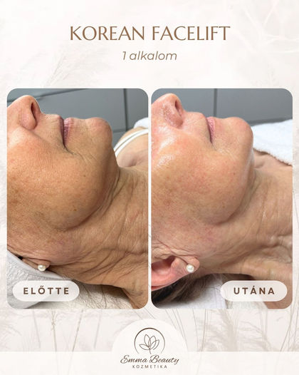 Emma Beauty koreai kozmetika Korean Facelift arckezelés eredmény előtte-utána