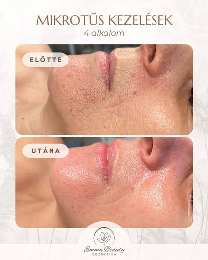 Biopen mikrotűs mezoterápia anti-aging kúra, koreai arckezelés, kollagén indukció