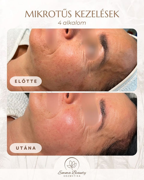 Biopen mikrotűs mezoterápia anti-aging kúra, koreai arckezelés, kollagén indukció