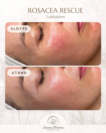 Koreai rosacea arckezelés, Emma Beauty kozmetika, Telki