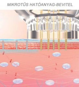 Biopen mikrotűs mezoterápia elektroporáció anti-aging fiatalító arckezelés
