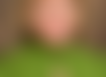 Measles: More Than Just a Little Rash