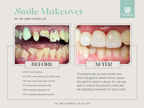 Dr. SmiLee Dental of Killeen, TX 76541, Dentist Office, Dentist near me, Dental Clinic, Dental clinic near me, Killeen Dentist, Harker Heights Dentist, Copperas Cove Dentist, Temple Dentist, Dental Implant, Family Dentist, Cosmetic Dentist, Emergency Dentist, Kid Friendly Dentist, IV Sedation, Invisalign, Braces, Facial esthetics, Botox, Dermal Fillers, PDO Threads, Facelift, Wrinkle Reduction, Trigger Point Therapy, Laser Hair Removal, IPL, Crown, Wisdom Tooth Extractions, Dentures, Dental Checkup Dental Cleaning, Oral Cancer Screening, Bridge, Esthetic Filling, Tooth Bonding, Teeth Whitening, Veneers, Root Canal Therapy