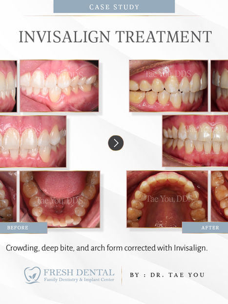 Fresh Dental Family Emergency Dentistry & Implant Center in Dallas, TX 75248 - Dental Implant, Cosmetic Dentistry, Family Dentistry, Emergency Dental Care, Teeth Whitening, Dental Checkups, Dental Cleaning, Fluoride Treatments, Dental Sealants, Oral Cancer Screening, Gum Disease Prevention, Invisalign, Clear Aligner, Porcelain Veneers, Smile makeover, Tooth fillings, Cosmetic Bonding, Dental Crown, Dental Bridges, Wisdom Tooth Extractions, Root Canal Therapy