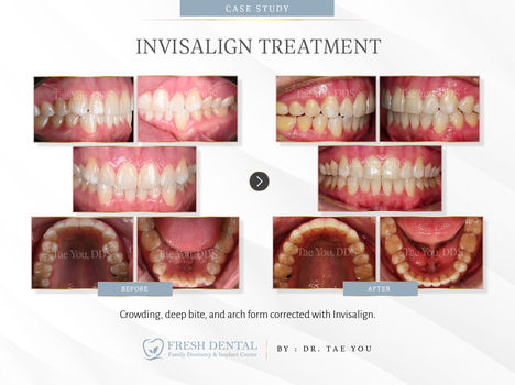 Fresh Dental Family Emergency Dentistry & Implant Center in Dallas, TX 75248 - Dental Implant, Cosmetic Dentistry, Family Dentistry, Emergency Dental Care, Teeth Whitening, Dental Checkups, Dental Cleaning, Fluoride Treatments, Dental Sealants, Oral Cancer Screening, Gum Disease Prevention, Invisalign, Clear Aligner, Porcelain Veneers, Smile makeover, Tooth fillings, Cosmetic Bonding, Dental Crown, Dental Bridges, Wisdom Tooth Extractions, Root Canal Therapy