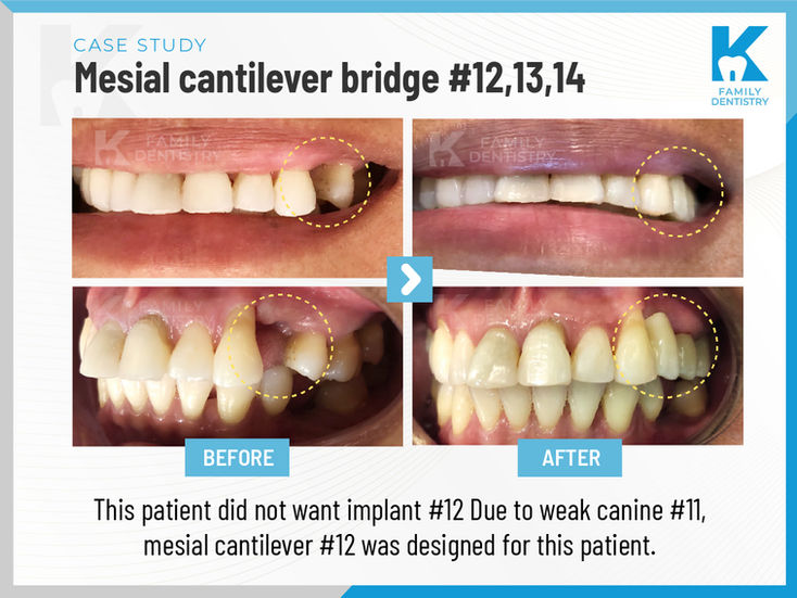 K Family Dentistry in Pflugerville, TX 78660 Emergency, Invisalign, Family ,Cosmetic - Dental Implants, Crowns, Bridges, Restorations, Veneers, Filling, Root Canal Therapy, ClearCorrect, Dentures, Teeth whitening, Inlays and onlays, Sedation Dentistry, Emergency Dentist, Kid Friendly Dentist, Dental Checkup, Cleaning & Examinations