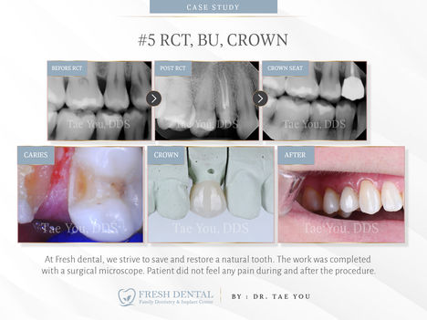 Fresh Dental Family Emergency Dentistry & Implant Center in Dallas, TX 75248 - Dental Implant, Cosmetic Dentistry, Family Dentistry, Emergency Dental Care, Teeth Whitening, Dental Checkups, Dental Cleaning, Fluoride Treatments, Dental Sealants, Oral Cancer Screening, Gum Disease Prevention, Invisalign, Clear Aligner, Porcelain Veneers, Smile makeover, Tooth fillings, Cosmetic Bonding, Dental Crown, Dental Bridges, Wisdom Tooth Extractions, Root Canal Therapy