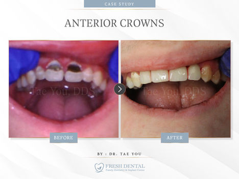 Fresh Dental Family & Implant Center in Dallas, TX 75248 - Dental Implant, Cosmetic Dentistry, Family Dentistry, Emergency Dental Care, Teeth Whitening, Dental Checkups, Dental Cleaning, Fluoride Treatments, Dental Sealants, Oral Cancer Screening, Gum Disease Prevention, Invisalign, Clear Aligner, Porcelain Veneers, Smile makeover, Tooth fillings, Cosmetic Bonding, Dental Crown, Dental Bridges, Wisdom Tooth Extractions, Root Canal Therapy