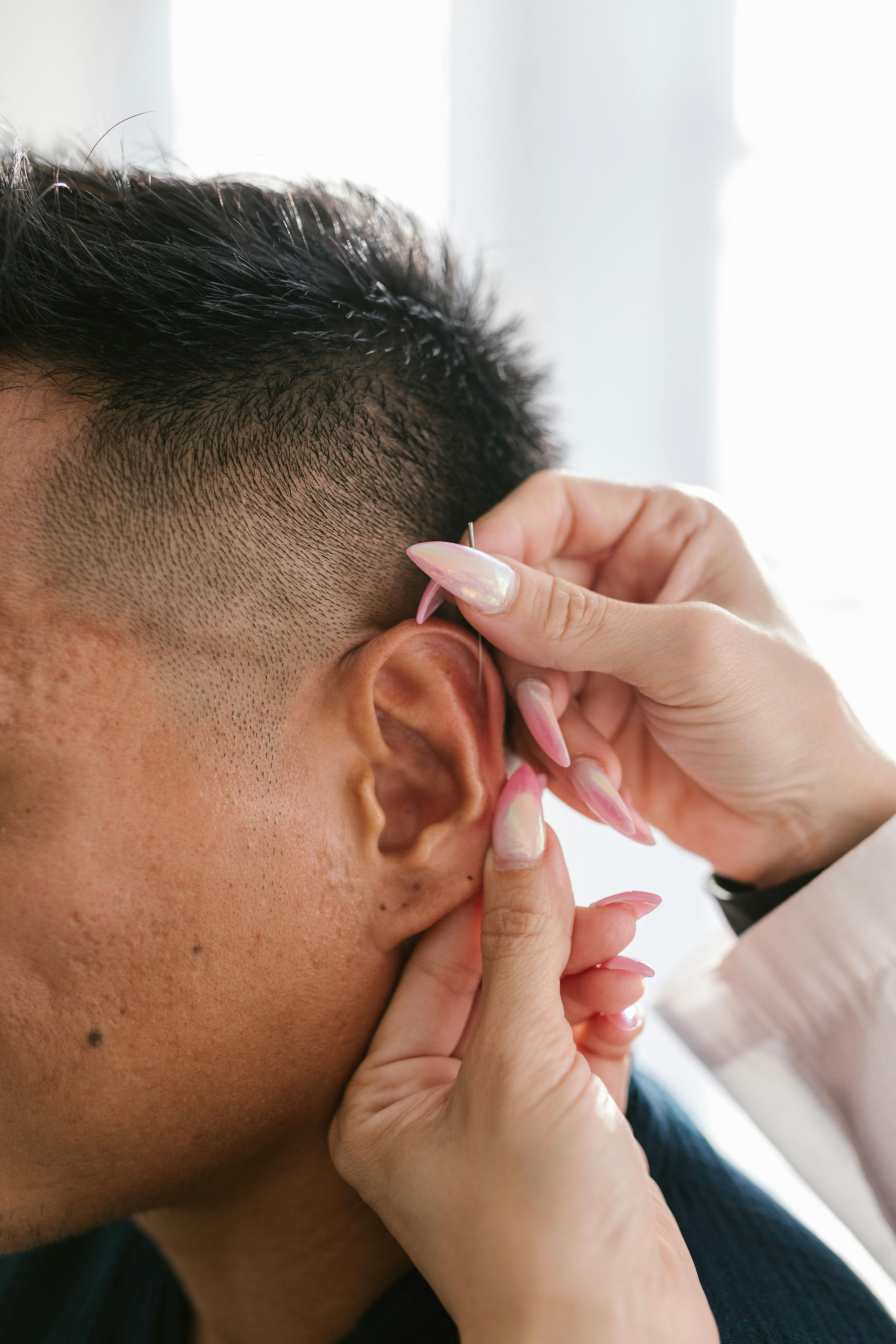 Auricular acupuncture being applied to the ear as part of integrative physiotherapy treatment