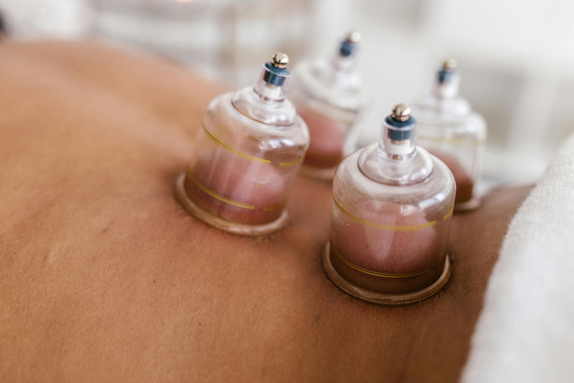 Cupping therapy applied to the lower back to help ease muscle tension.