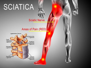 Sciatica Pain Relief Malta