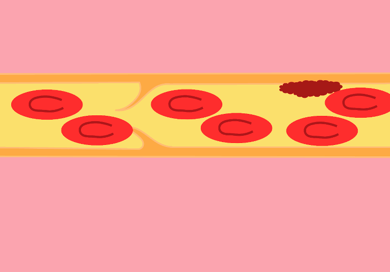 Thrombosis_formation