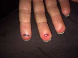 Meine gequetschte Hand