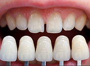 veneers-and-laminates-treatment-500x500.