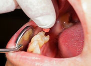 endodontic-surgery-1835421743..jpg