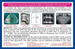 Article Published in Journal of prosthetic dentistry ( JOPD), Accredited in DCI Journal/Consorium 20