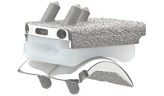 Stryker Infinity Total Ankle replacement