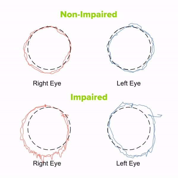 A GIF illustrating the difference between normal smooth pursuits and impaired smooth pursuits. In the normal segment, eye movements are smooth, fluid, and accurately track a moving object. In the impaired segment, eye movements appear irregular, jerky, and less coordinated, indicating challenges in smoothly tracking objects and suggesting potential visual coordination issues.