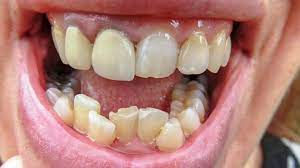 Crooked Teeth Treatment In Dubai