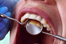 Does Teeth Scaling Help With Bad Breath?