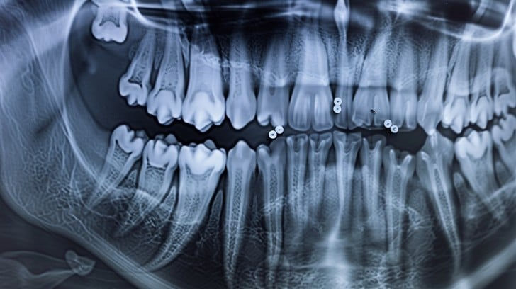 What Does a Dentist Look for in a Panoramic X-Ray?