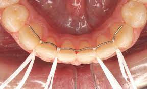 Dental Retainers In Dubai