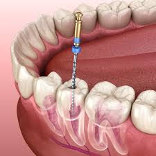 Root Canal Treatment in Dubai