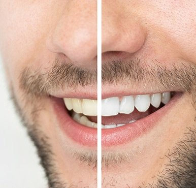 Can Teeth Whitening Remove Yellow Stains?