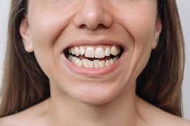 Straightening Overlapping Teeth, A Step-by-Step Approach