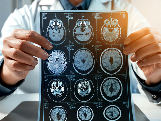 Científicos rusos desarrollan test para la detección temprana del alzhéimer