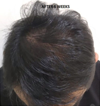 Thumbnail: Calecim Advanced Hair System 6x5ml