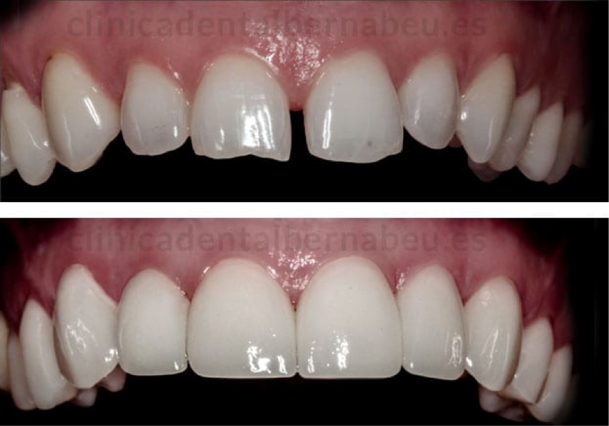 Caso clínico de carillas dentales
