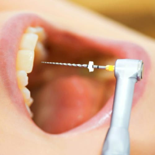ENDODONCIA