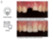 IMPLANT WORKUP ENG.002.jpeg