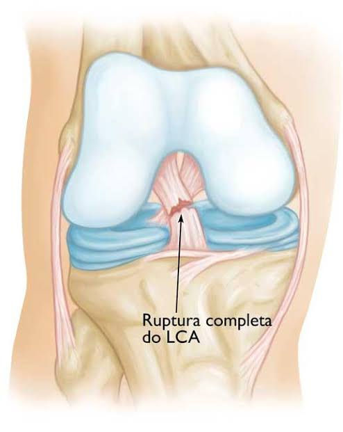 Ligamento cruzado anterior rompido